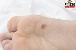 plantar warts symptoms,foot wart pain,causes of plantar warts,