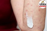 Purpura causes and symptoms,Purple spots on skin reasons,Low platelet count skin rashes,