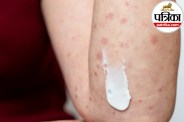 Purpura causes and symptoms,Purple spots on skin reasons,Low platelet count skin rashes,