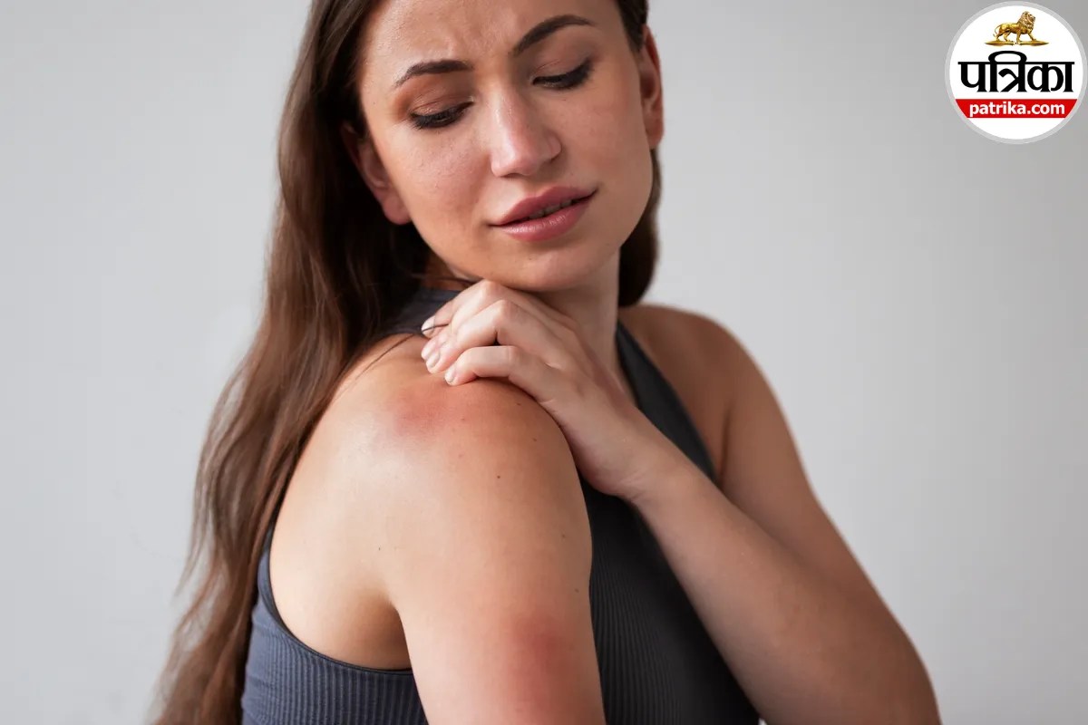 Radiation burn on human skin showing redness and peeling from cancer therapy