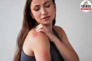 Radiation burn on human skin showing redness and peeling from cancer therapy