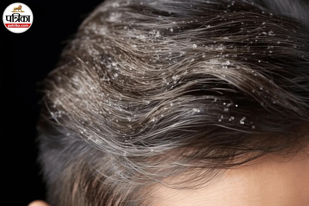 Seborrheic Dermatitis Causes, Seborrheic Dermatitis Treatment