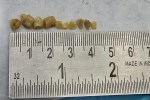 Not just one or two, but 10 stones in the salivary duct! A rare medical case in India