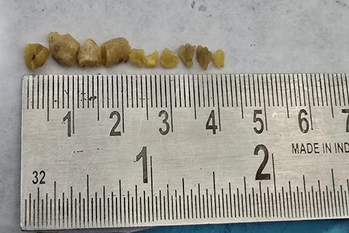Not just one or two, but 10 stones in the salivary duct! A rare medical case in India
