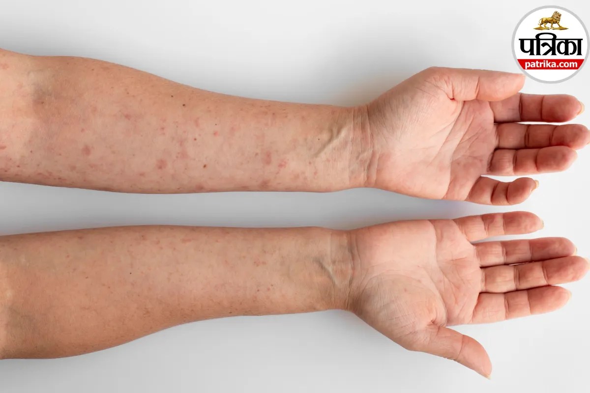 variola virus symptoms and causes,smallpox virus transmission hindi,variola virus complications,