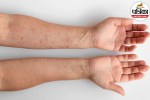 variola virus symptoms and causes,smallpox virus transmission hindi,variola virus complications,