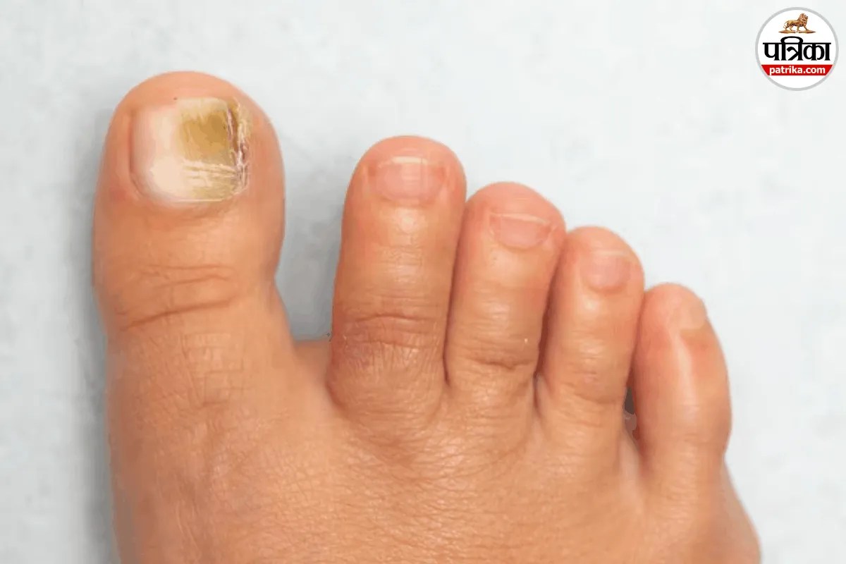 Toenail Fungus, Yellow Nail Syndrome