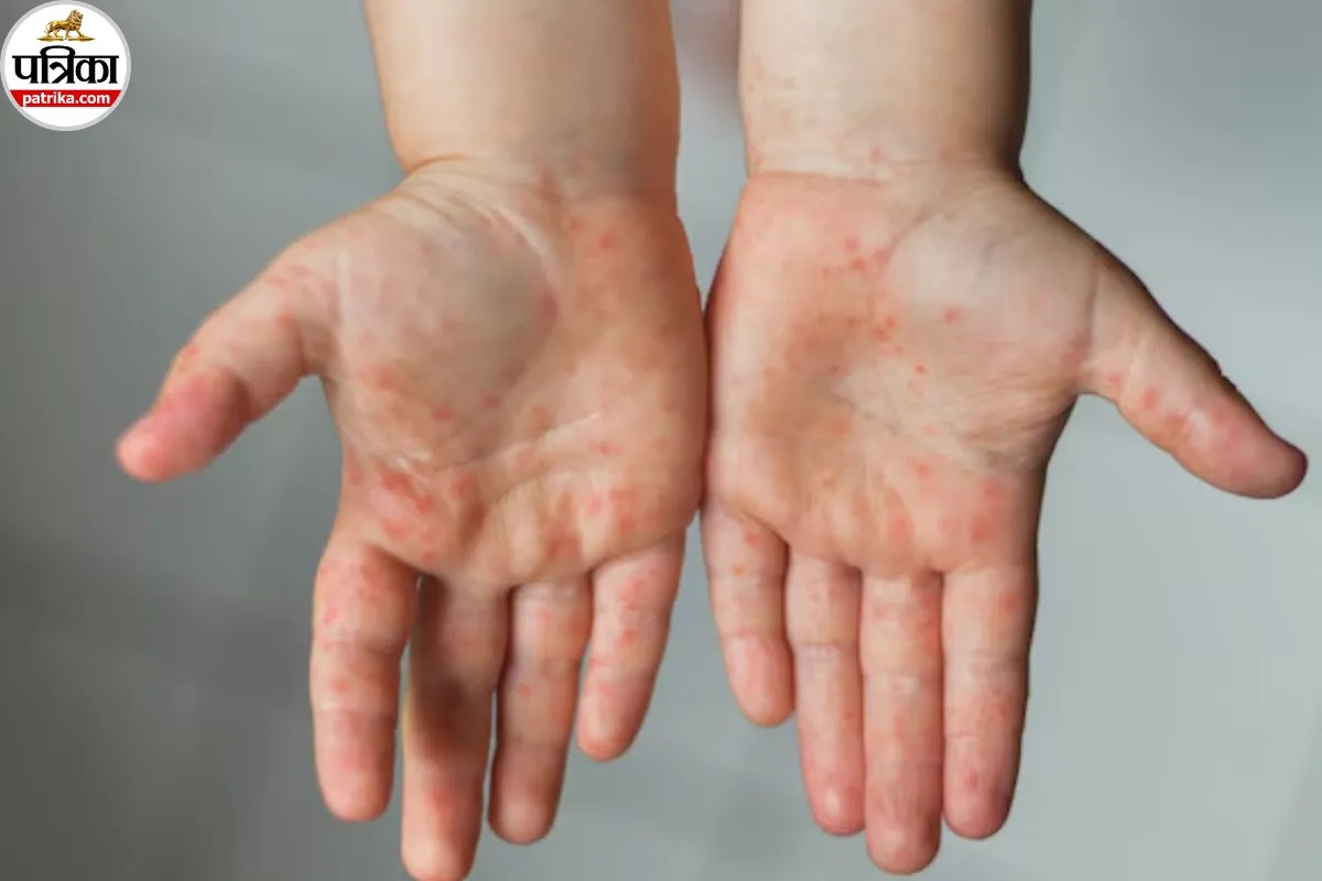 HFMD Causes, HFMD Treatment