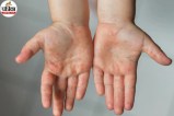 HFMD Causes, HFMD Treatment