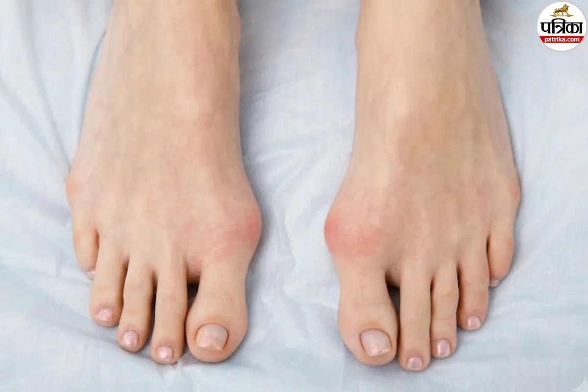 tailor's bunion symptoms,bunionette on pinky toe,tailor's bunion causes and treatment,