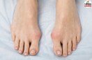 tailor's bunion symptoms,bunionette on pinky toe,tailor's bunion causes and treatment,