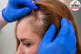 Person examining hair thinning and hair loss on scalp in mirror representing baldness awareness