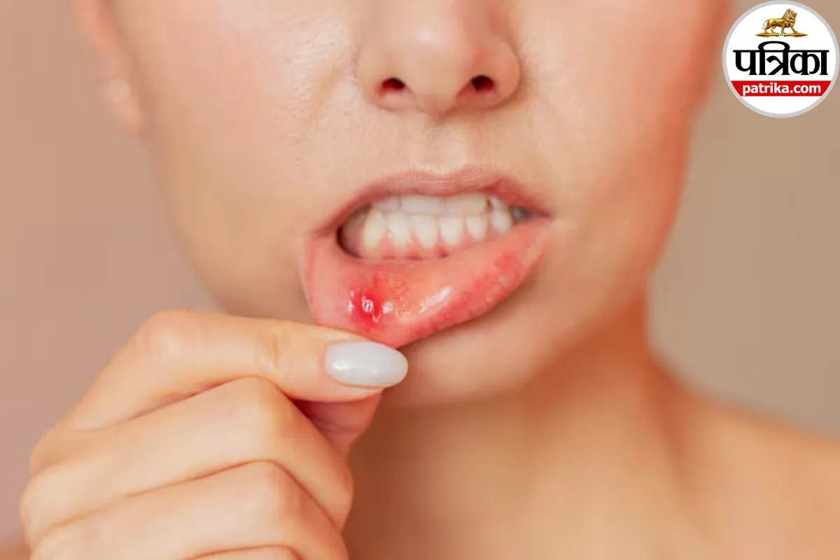 Person showing mouth ulcer or canker sore inside the cheek for medical awareness
