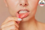Person showing mouth ulcer or canker sore inside the cheek for medical awareness