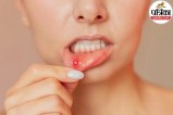 Person showing mouth ulcer or canker sore inside the cheek for medical awareness