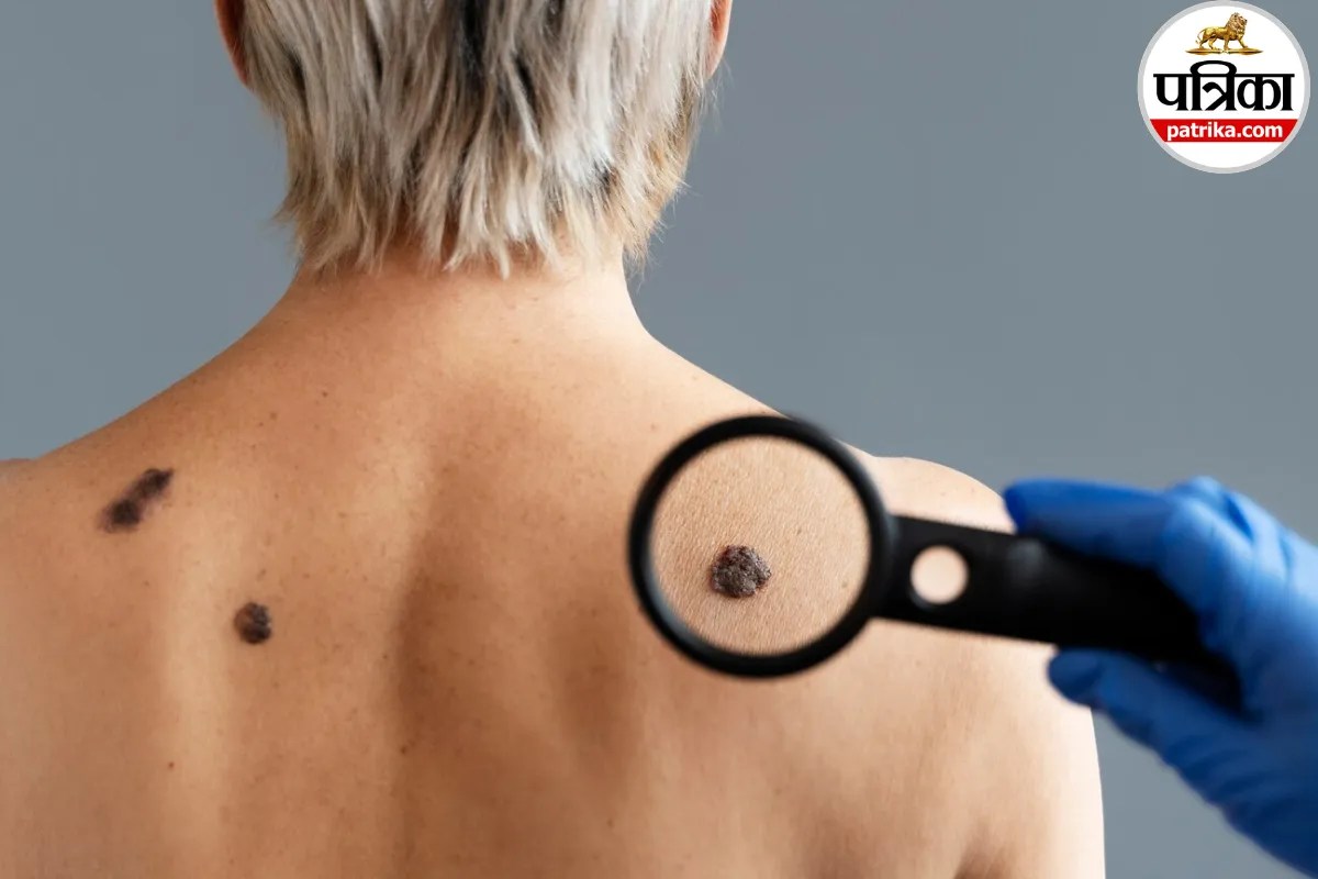 Dermatologist examining a non-healing skin lesion on patient's skin for basal cell carcinoma diagnosis