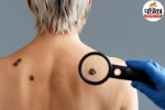 Dermatologist examining a non-healing skin lesion on patient's skin for basal cell carcinoma diagnosis