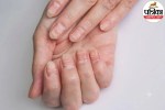 Close-up of human fingernails showing horizontal grooves and ridges known as Beau's lines, indicating underlying health issues or past illness.