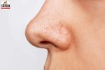 Blackheads Causes
