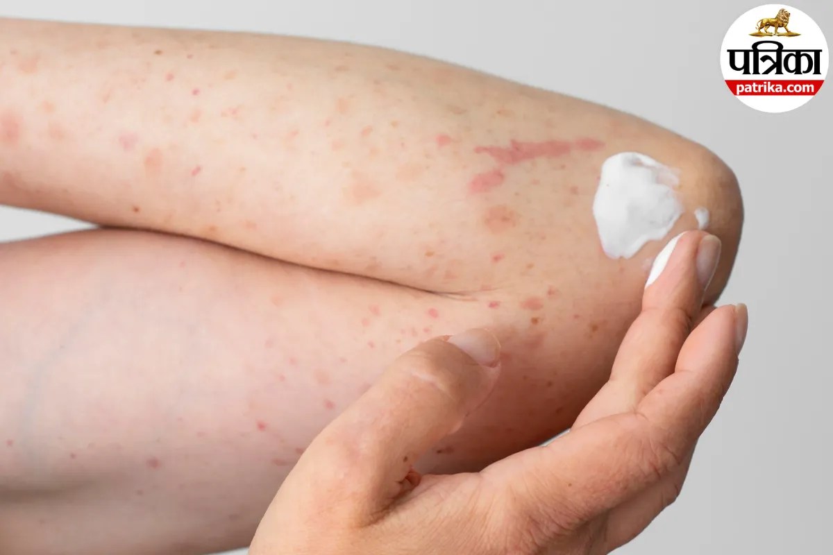 Close-up view of a red, irritated bug bite on human skin showing swelling and inflammation.