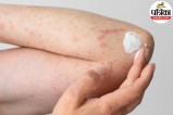 Close-up view of a red, irritated bug bite on human skin showing swelling and inflammation.