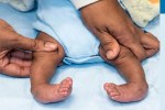 Congenital Clubfoot