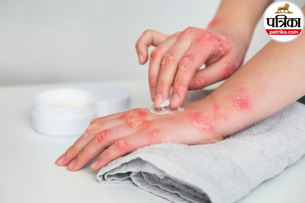 Red itchy rash and skin irritation on hand caused by contact dermatitis from jewelry or soap