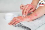 Red itchy rash and skin irritation on hand caused by contact dermatitis from jewelry or soap