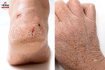 Cracked Heels