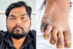 Cushing Syndrome Case Kota