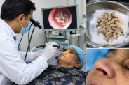 Damoh Woman Nose Fly Larvae
