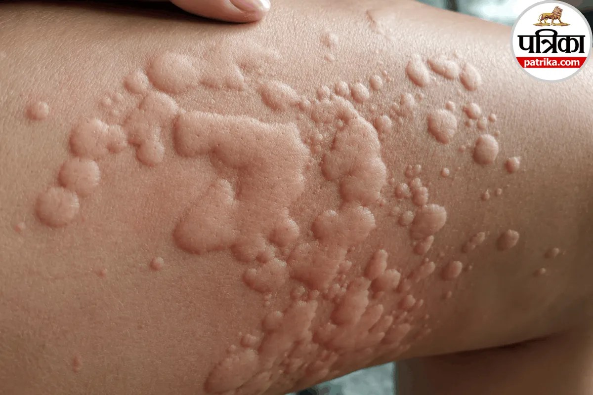 Close-up of skin swelling and red wheals caused by delayed pressure urticaria from tight clothing.