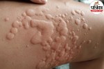 Close-up of skin swelling and red wheals caused by delayed pressure urticaria from tight clothing.