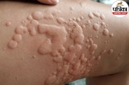 Close-up of skin swelling and red wheals caused by delayed pressure urticaria from tight clothing.