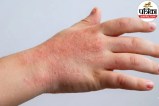 Close-up photo of a child's hand showing a distinct red, dry, and scaly skin rash, characteristic of discoid eczema (nummular dermatitis).