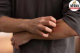 Skin redness and rash without injury representing Erythema symptoms on human skin
