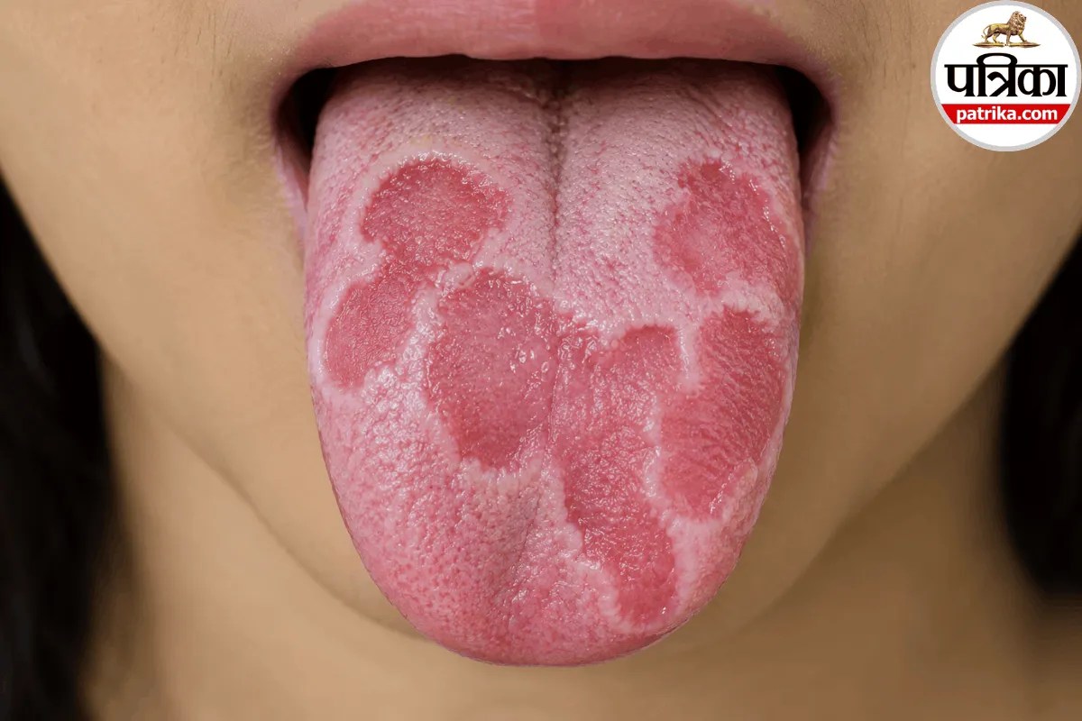 Close-up view of a person showing red and smooth patches on tongue indicating geographic tongue