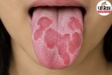Close-up view of a person showing red and smooth patches on tongue indicating geographic tongue