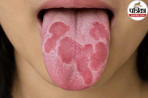 Close-up view of a person showing red and smooth patches on tongue indicating geographic tongue