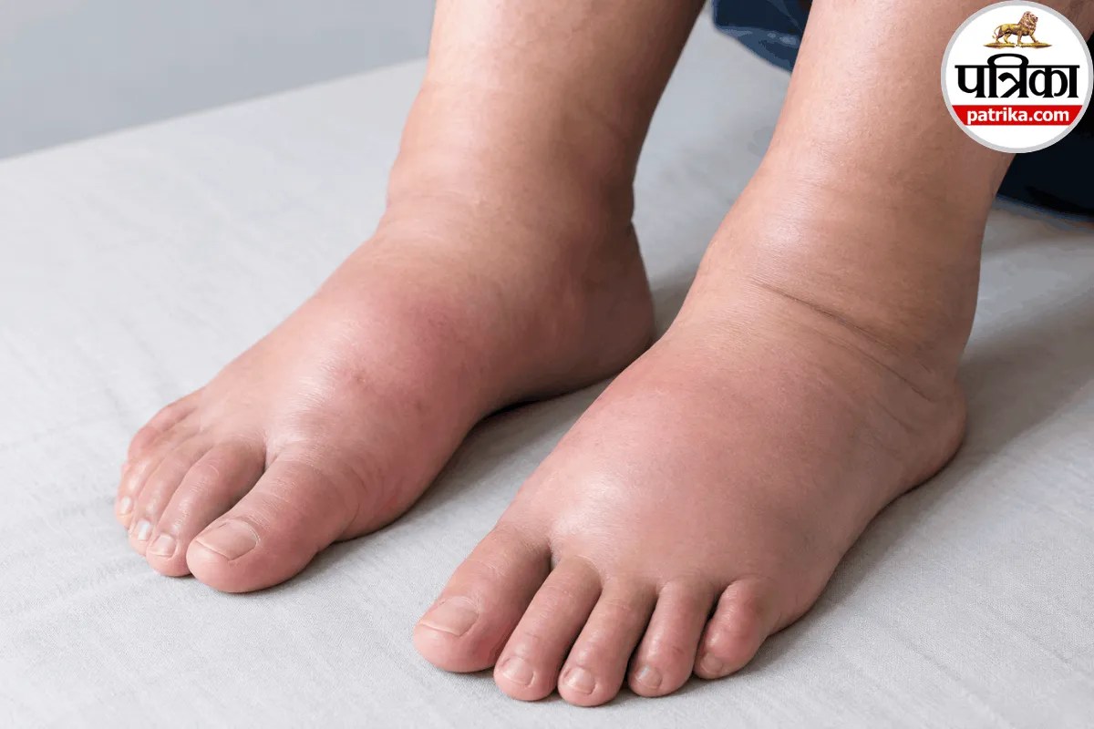 Swollen feet and legs warning signs related to lung cancer and blood clots