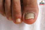 Toenail separating from the nail bed due to onycholysis