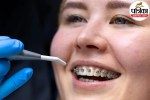 palatal expander for kids teeth crowding and narrow jaw orthodontic treatment