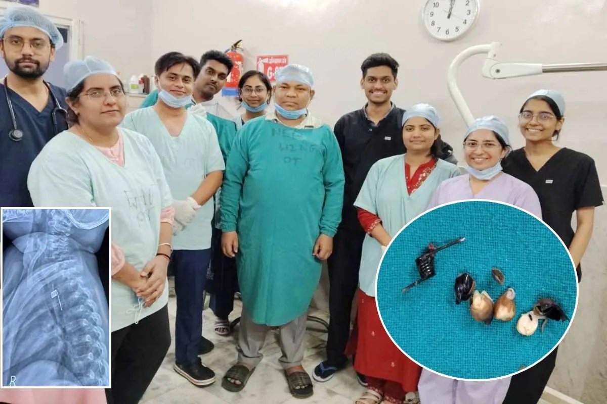 बच्ची के गले में फंसी थी स्प्रिंग, परिजन ने खिला दिए चने, रीवा में डॉक्टर्स ने बचाई जान