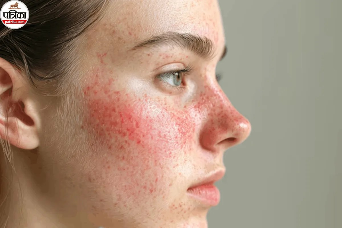 Rosacea, Rosacea Symptoms