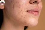 Skin Breakouts