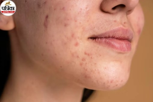 Skin Breakouts