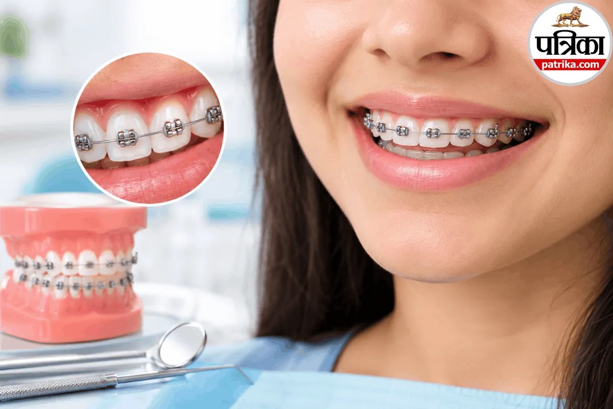 Patient smiling after getting metal teeth braces for alignment correction