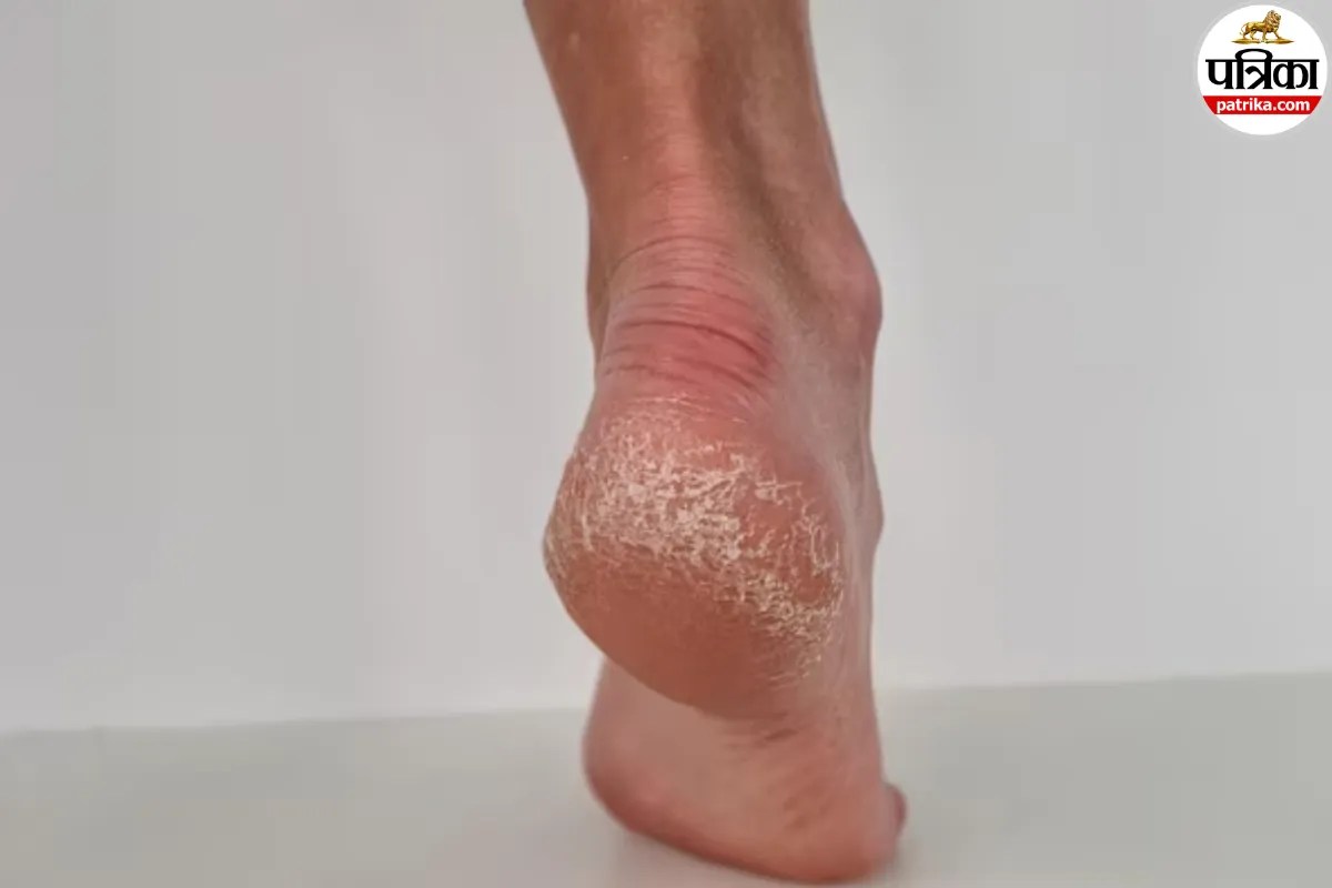 Winter Foot Care Tips To Treat Cracked Heels