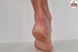 Winter Foot Care Tips To Treat Cracked Heels