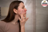 Dry and scaly skin on hands and arms showing symptoms of xerosis during winter season